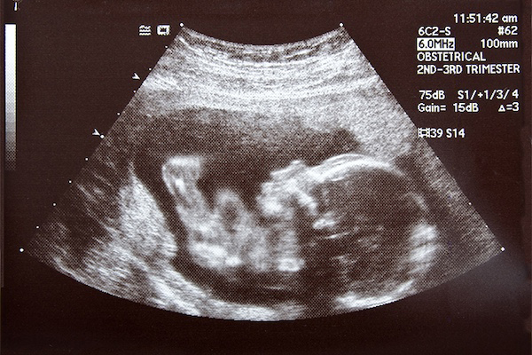 Ultrasound Photo